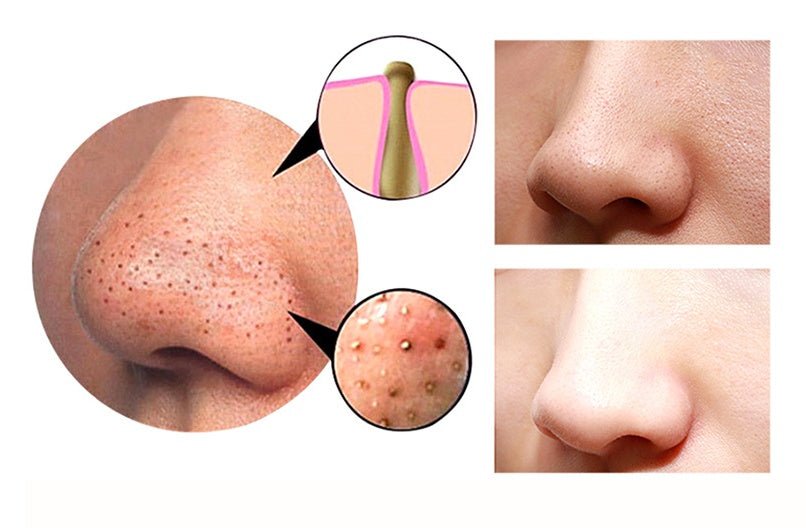 4-in-1 Blackhead Remover - Guasha Cupping Facial Pore Cleansing Device