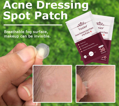 Invisible Acne Pimple Patches - Hydrocolloid Spot Treatment Stickers
